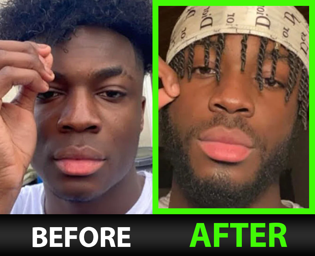 Before and after — Albert C.